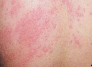 湿疹可以吃八棱瓜吗